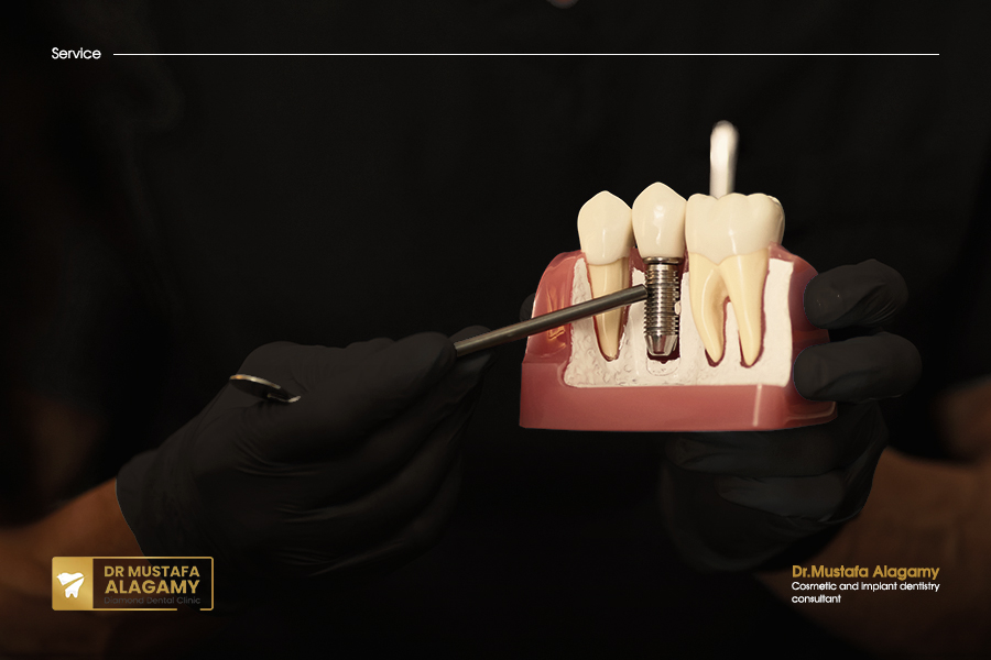 Dental implants